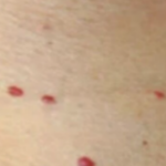 Red dots on your skin: Causes and what they could mean